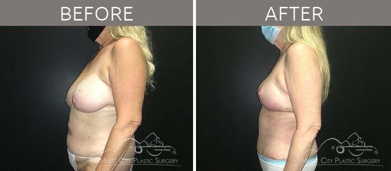 Breast Reduction with Lift Before & After Gallery - Patient 132099790 - Image 1