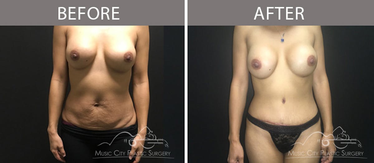 Mommy Makeover Before & After Gallery - Patient 90709166 - Image 1