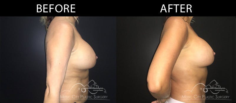 Abdominoplasty Before & After Gallery - Patient 90709162 - Image 3