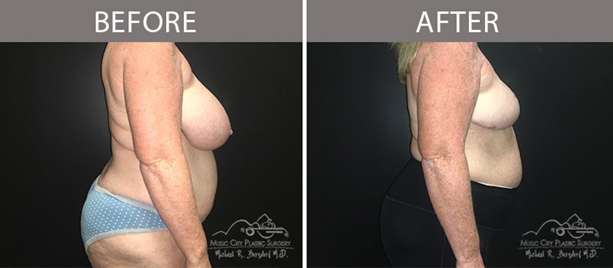 Capsulectomy Before & After Gallery - Patient 90709163 - Image 5
