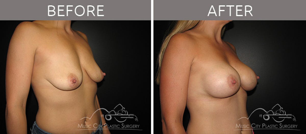 Breast Augmentation Before & After Gallery - Patient 90709165 - Image 2