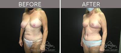 Breast Reduction with Lift Before & After Gallery - Patient 132099790 - Image 2