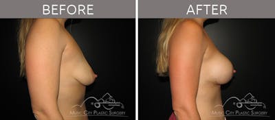 Breast Augmentation Before & After Gallery - Patient 90709165 - Image 3