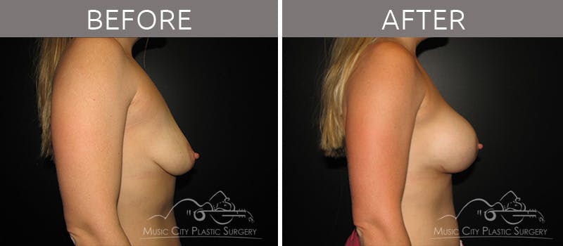Breast Augmentation Before & After Gallery - Patient 90709165 - Image 3