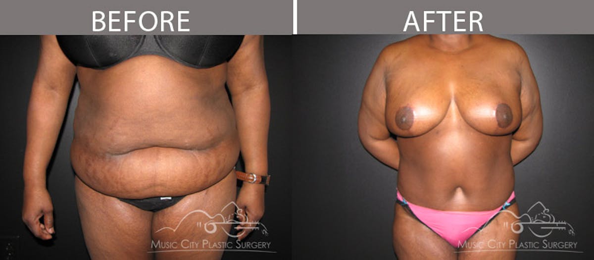 Abdominoplasty Before & After Gallery - Patient 90709168 - Image 1