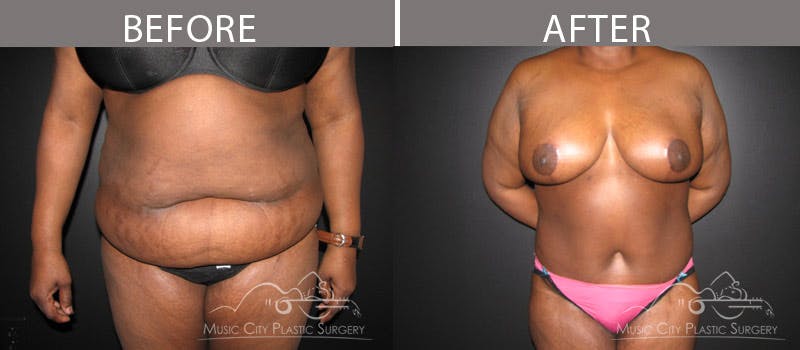 Abdominoplasty Before & After Gallery - Patient 90709168 - Image 1