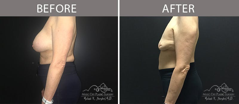 Capsulectomy Before & After Gallery - Patient 90709187 - Image 1