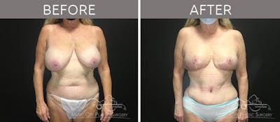 Breast Reduction with Lift Before & After Gallery - Patient 132099790 - Image 1