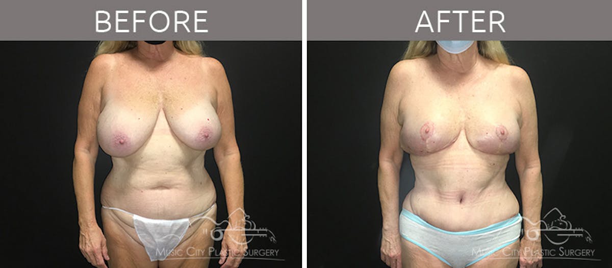 Breast Reduction with Lift Before & After Gallery - Patient 132099790 - Image 1