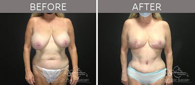 Breast Reduction with Lift Before & After Gallery - Patient 132099790 - Image 3