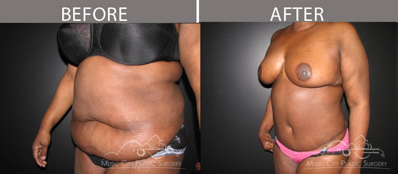 Abdominoplasty Before & After Gallery - Patient 90709168 - Image 2