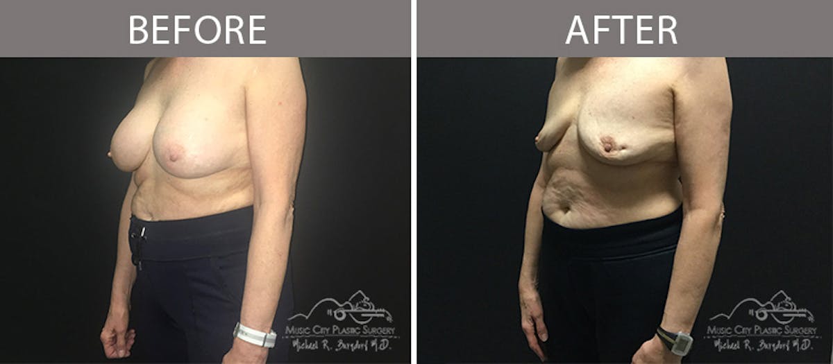 Capsulectomy Before & After Gallery - Patient 90709187 - Image 2