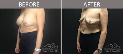 Capsulectomy Before & After Gallery - Patient 90709187 - Image 2