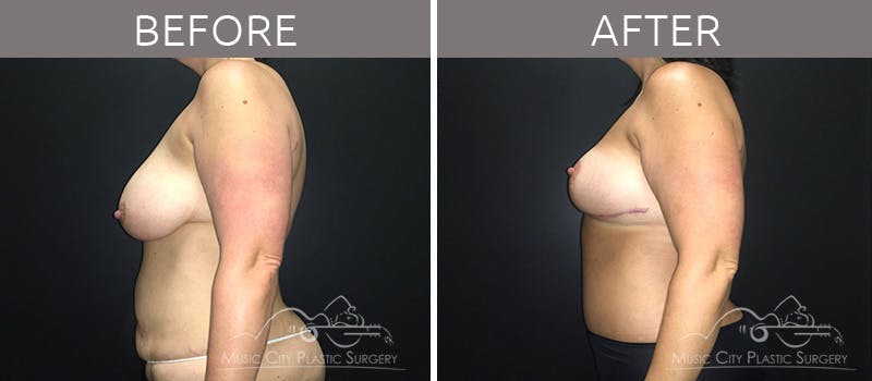 Mommy Makeover Before & After Gallery - Patient 90709178 - Image 1