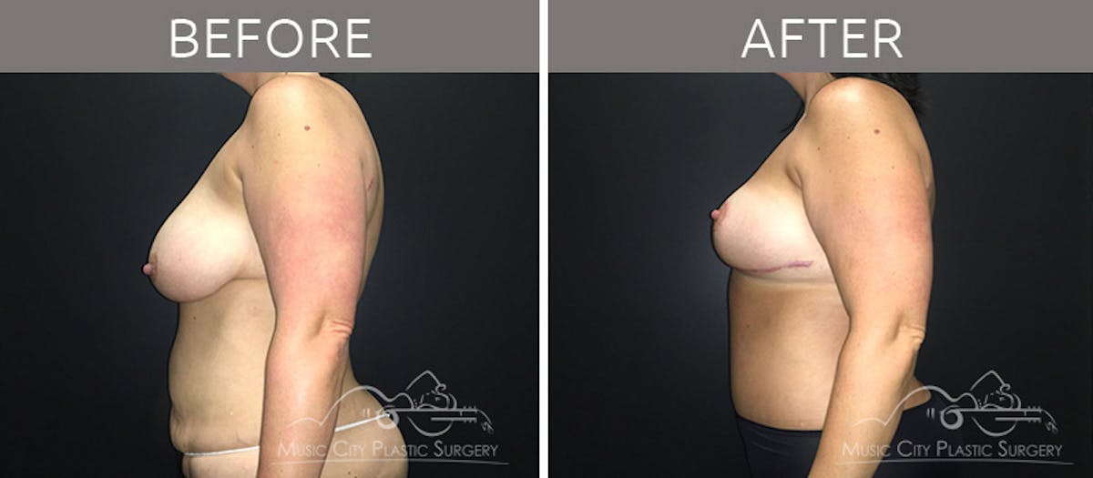 Mommy Makeover Before & After Gallery - Patient 90709178 - Image 3