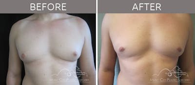 Gynecomastia Before & After Gallery - Patient 90709169 - Image 2