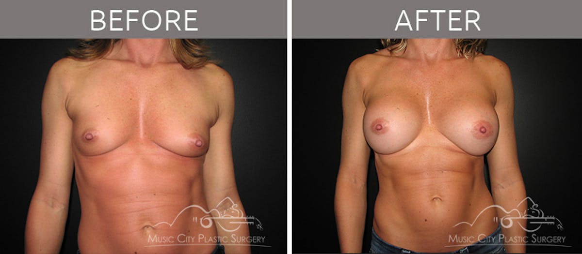 Breast Augmentation Before & After Gallery - Patient 90709176 - Image 1