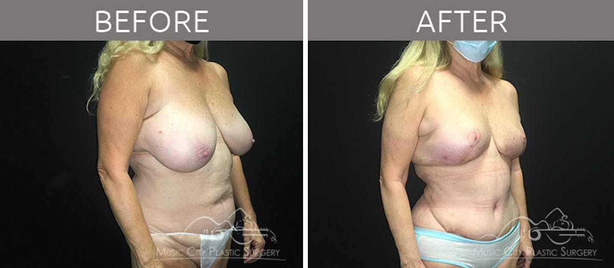 Breast Reduction with Lift Before & After Gallery - Patient 132099790 - Image 4