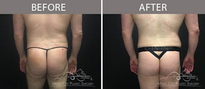 Brazilian Butt Lift Before & After Gallery - Patient 90709167 - Image 2