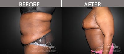 Abdominoplasty Before & After Gallery - Patient 90709168 - Image 3