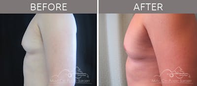 Gynecomastia Before & After Gallery - Patient 90709169 - Image 3