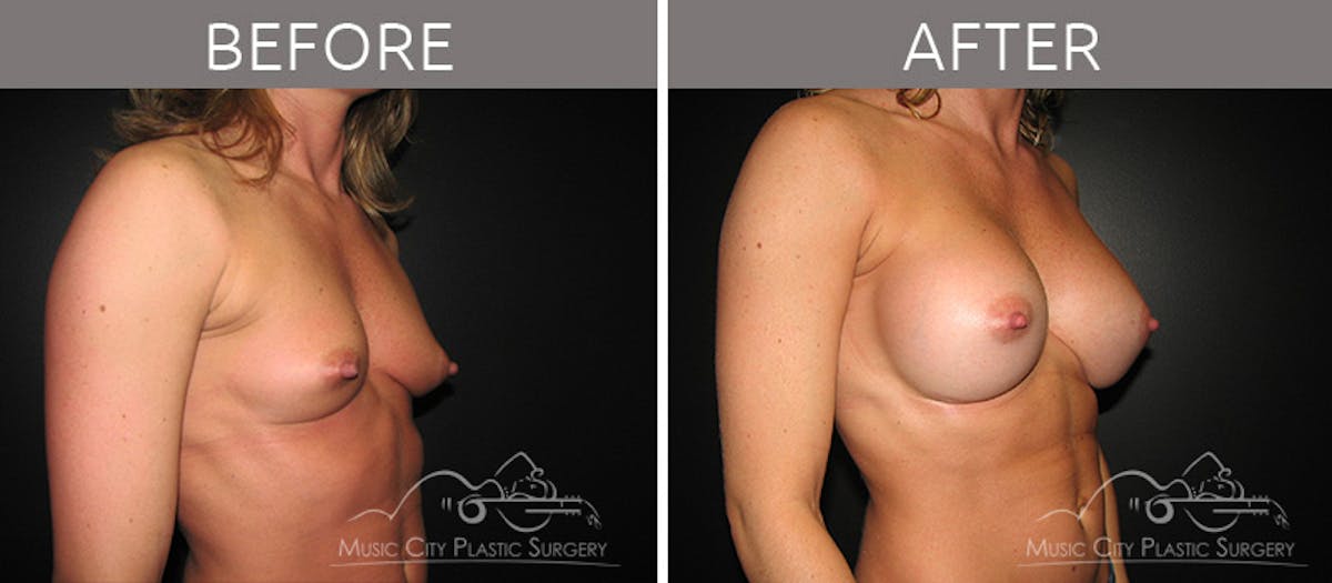 Breast Augmentation Before & After Gallery - Patient 90709176 - Image 2