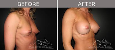 Breast Augmentation Before & After Gallery - Patient 90709176 - Image 2
