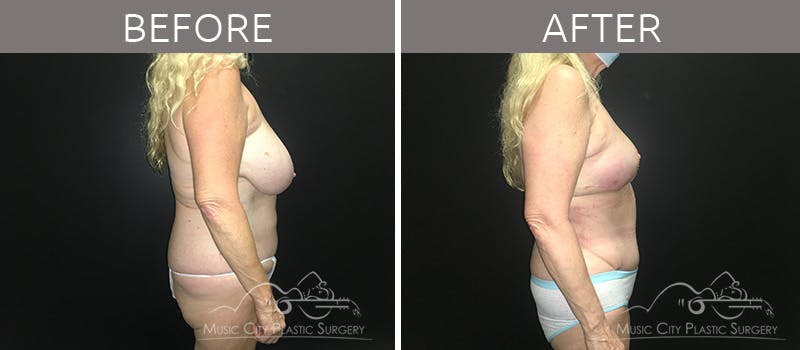 Breast Reduction with Lift Before & After Gallery - Patient 132099790 - Image 5