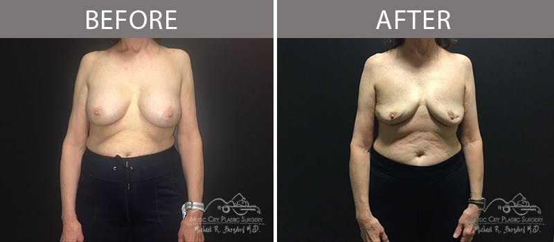 Capsulectomy Before & After Gallery - Patient 90709187 - Image 3