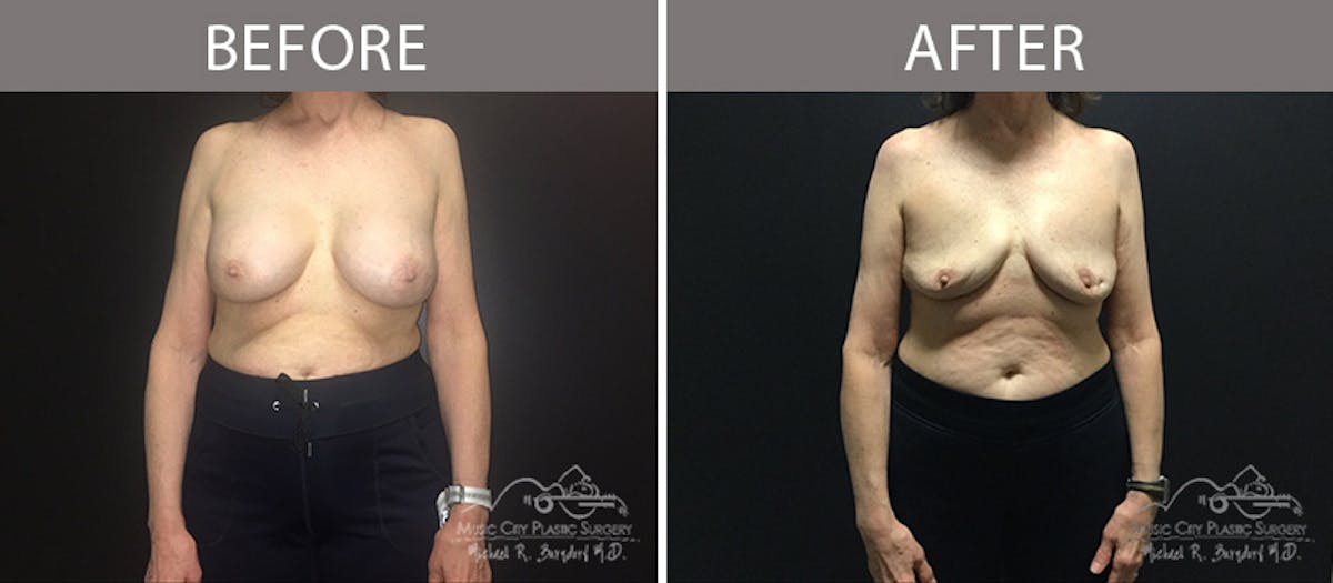 Capsulectomy Before & After Gallery - Patient 90709187 - Image 1