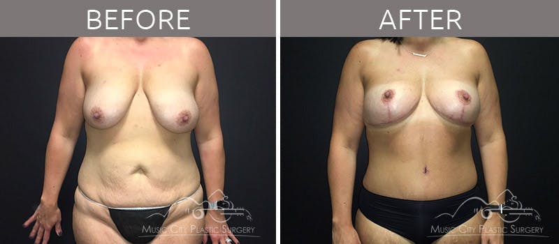 Mommy Makeover Before & After Gallery - Patient 90709178 - Image 2