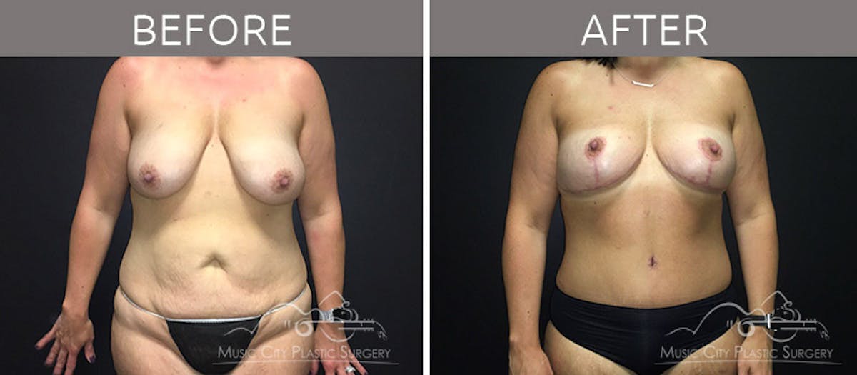 Mommy Makeover Before & After Gallery - Patient 90709178 - Image 1