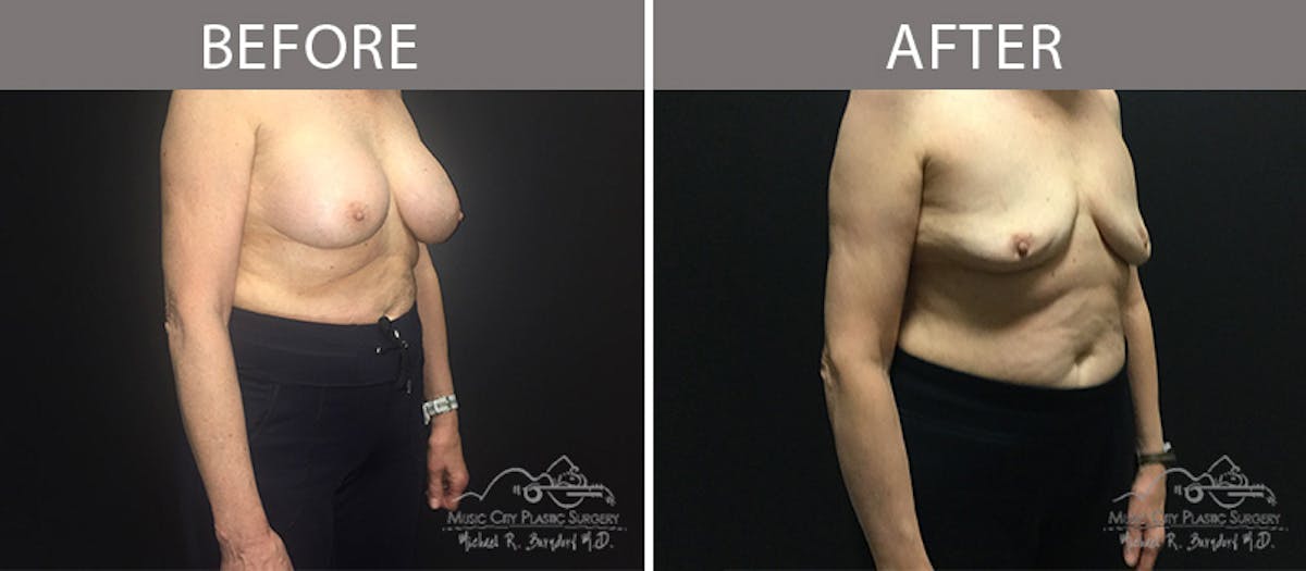 Capsulectomy Before & After Gallery - Patient 90709187 - Image 4