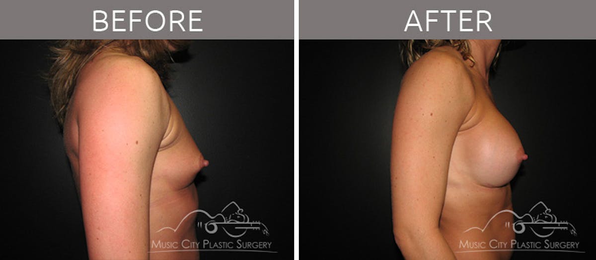 Breast Augmentation Before & After Gallery - Patient 90709176 - Image 3