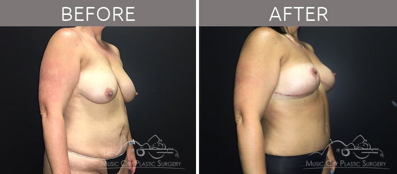 Mommy Makeover Before & After Gallery - Patient 90709178 - Image 3