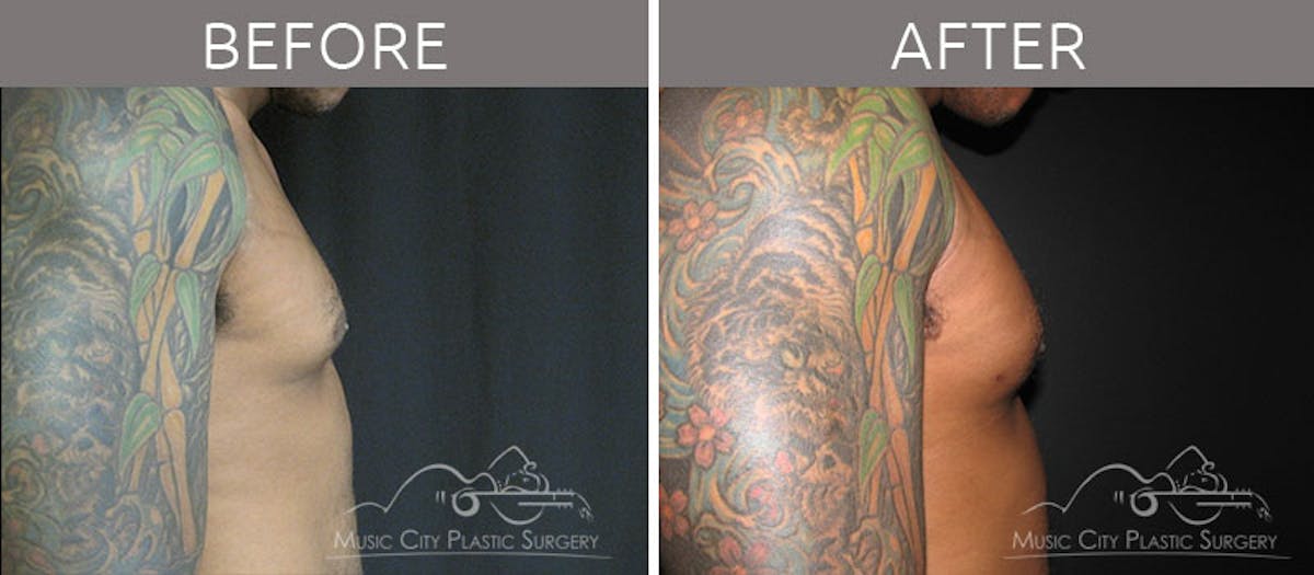 Gynecomastia Before & After Gallery - Patient 90709188 - Image 1