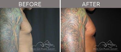 Gynecomastia Before & After Gallery - Patient 90709188 - Image 1
