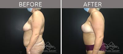 Breast Lift Before & After Gallery - Patient 90709191 - Image 3