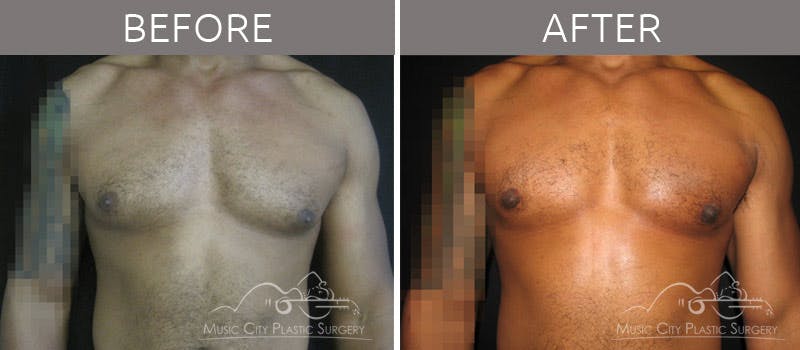 Gynecomastia Before & After Gallery - Patient 90709188 - Image 2