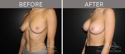 Breast Augmentation Before & After Gallery - Patient 90709190 - Image 2