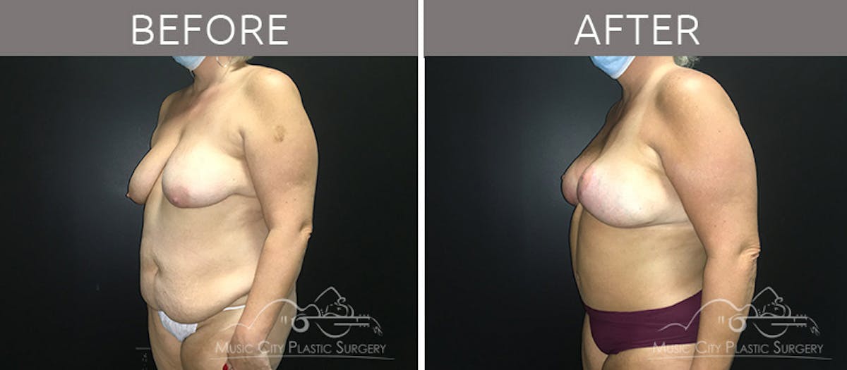Breast Lift Before & After Gallery - Patient 90709191 - Image 2