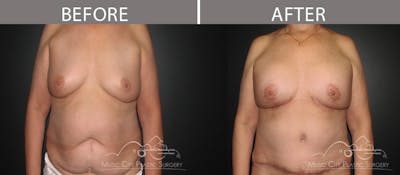 Abdominoplasty Before & After Gallery - Patient 90709189 - Image 1