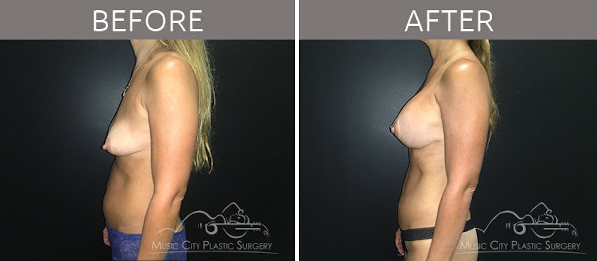 Mommy Makeover Before & After Gallery - Patient 90709199 - Image 3