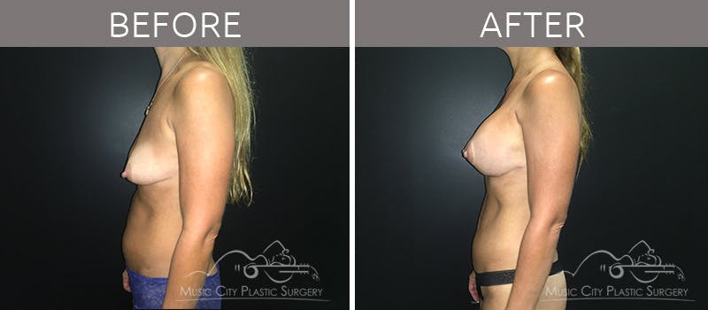 Mommy Makeover Before & After Gallery - Patient 90709199 - Image 2