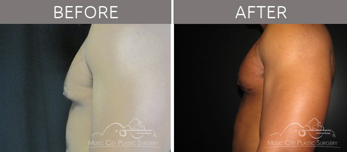 Gynecomastia Before & After Gallery - Patient 90709188 - Image 3