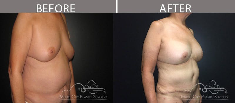 Abdominoplasty Before & After Gallery - Patient 90709189 - Image 2