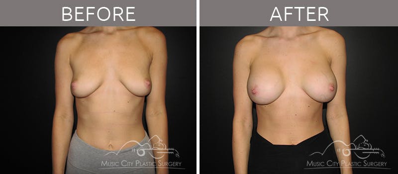 Breast Augmentation Before & After Gallery - Patient 90709190 - Image 2