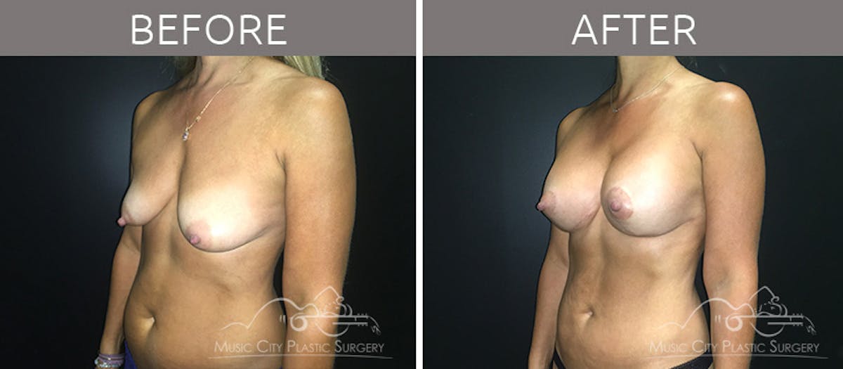 Mommy Makeover Before & After Gallery - Patient 90709199 - Image 2