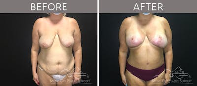 Breast Lift Before & After Gallery - Patient 90709191 - Image 1