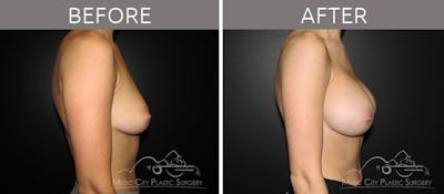 Breast Augmentation Before & After Gallery - Patient 90709190 - Image 3